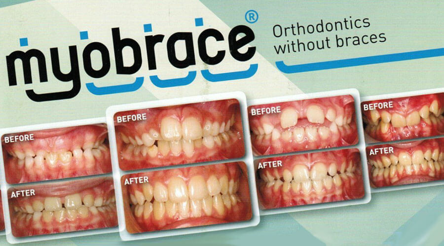 MyoBrace Before and After